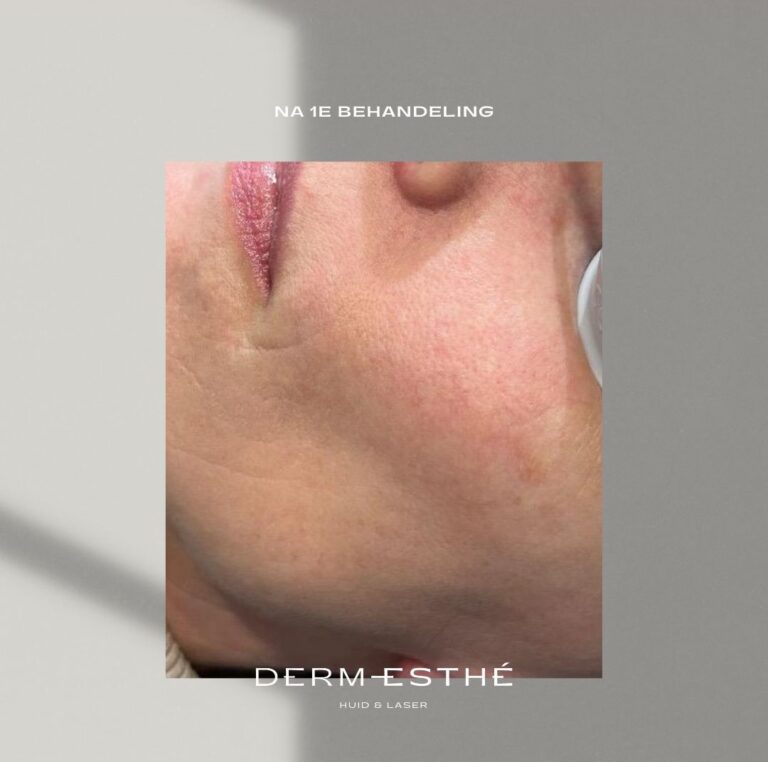 Na couperosebehandeling