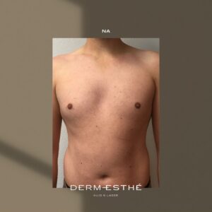 Resultaat na zes laserbehandelingen met de Soprano ICE platinum laser in Huizen