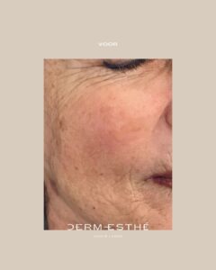 pigmentlaserbehandeling
