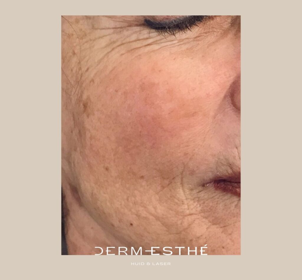 pigmentlaserbehandeling