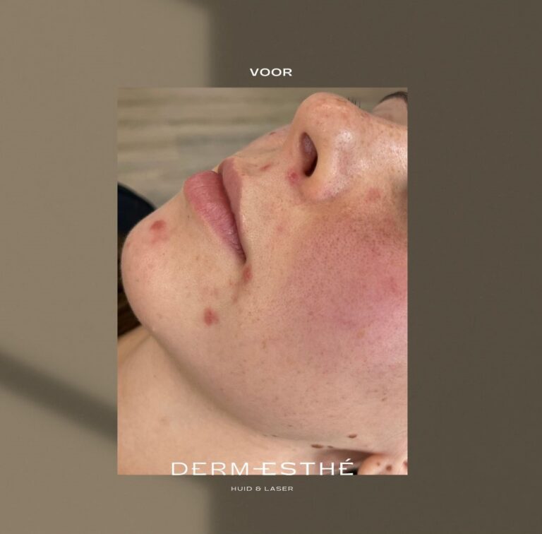 Acnetherapie dermesthe huizen