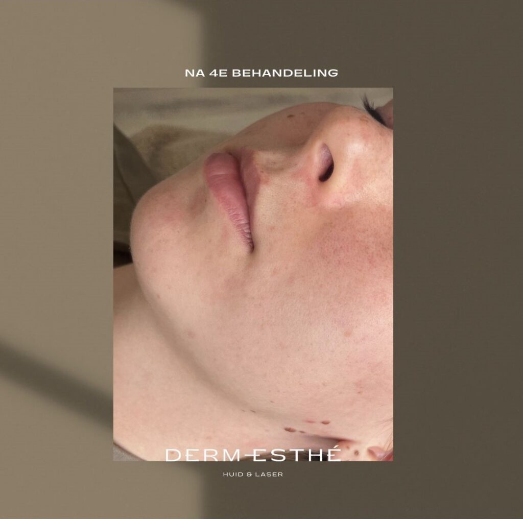 Acnetherapie dermesthe huizen