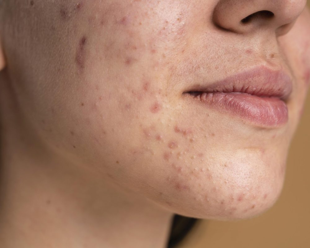 acne-littekens acne-littekens